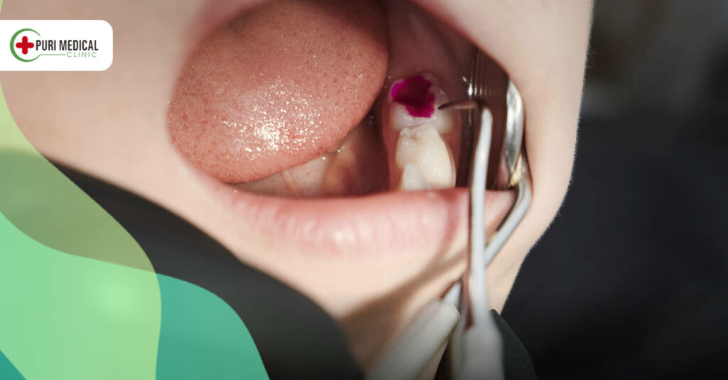 Tooth cavity, also known as dental caries or decay, are a prevalent oral health issue affecting people of all ages worldwide. 